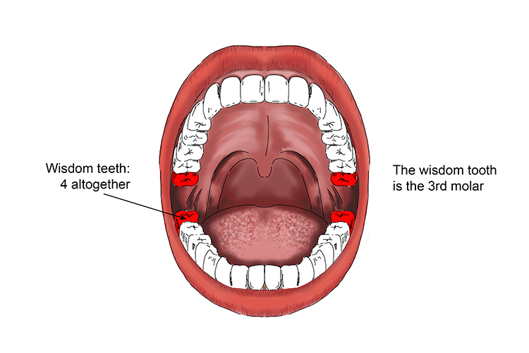 Wisdom teeth are found at the very back of the mouth as the third molars